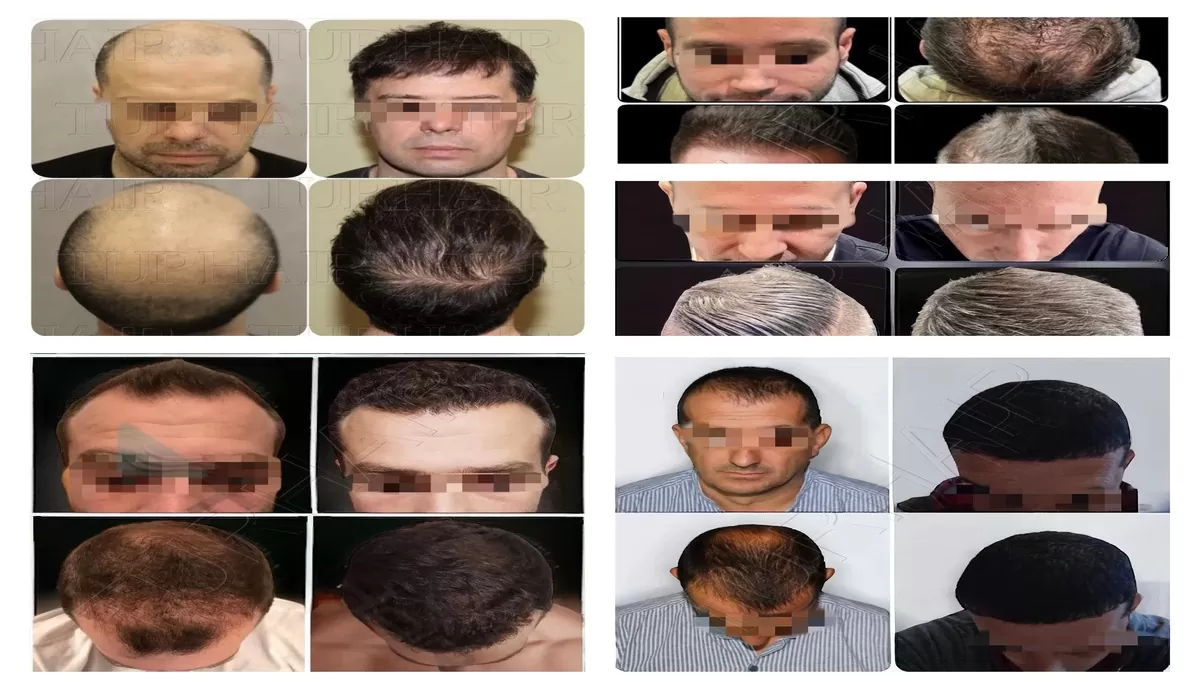 Медицински туризъм в Турция VIP трансплантация на коса с Turhair